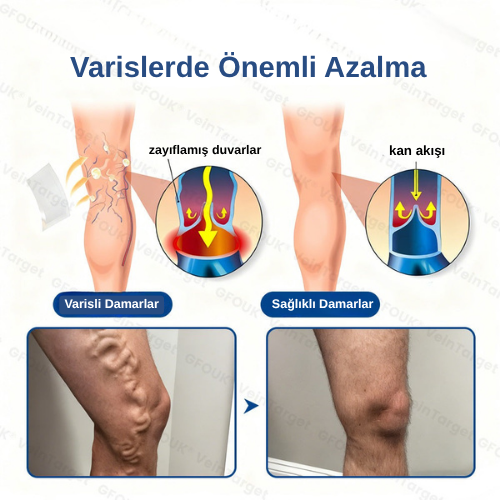 Mikroiğneli Varis Bandı