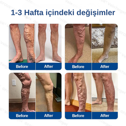 Mikroiğneli Varis Bandı